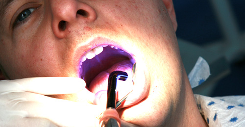 Painless treatment of cavities