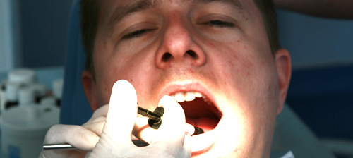 Painless treatment of cavities